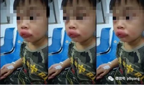 男孩吃葡萄過(guò)敏腫成嘟嘟嘴怎么回事？畫面詳情曝光網(wǎng)友忍不住笑了